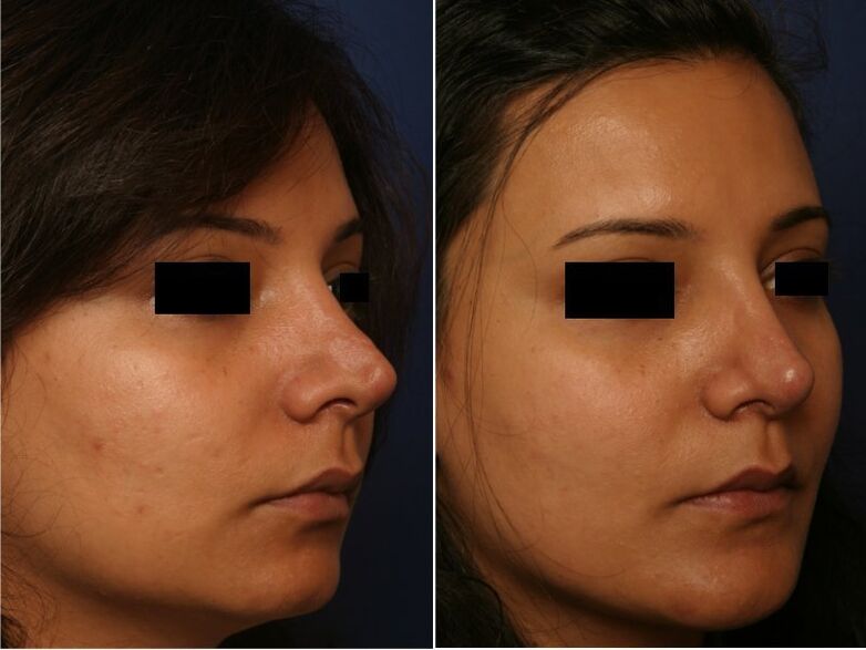 Ergebnis einer plastischen Operation