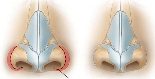 Verkleinerung der Nasengänge