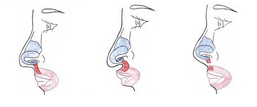 Verkürzung eines Teils des Nasenmuskels.