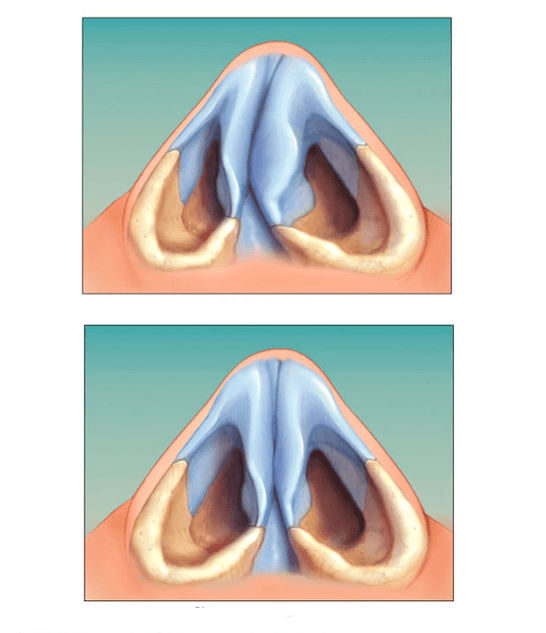 korrigiertes Nasenseptum