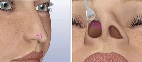 Nasenkorrektur bei geschlossener Nase