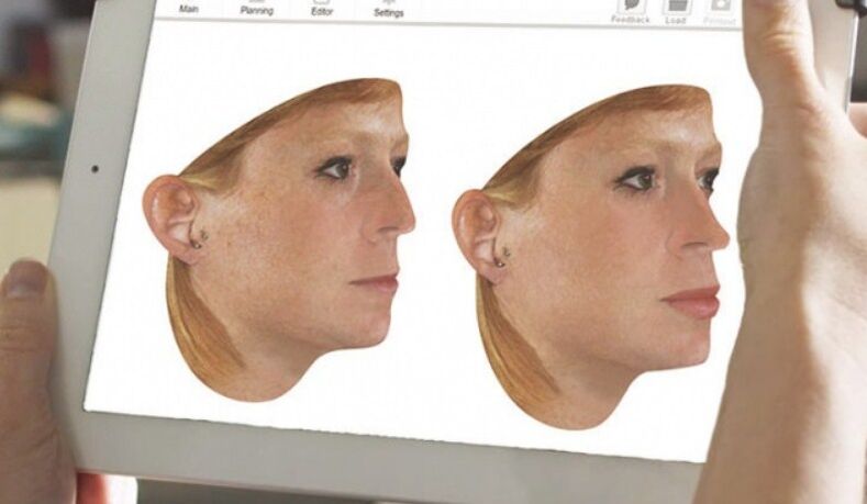 Computermodellierungsmethode der Nase vor der Nasenkorrektur. 