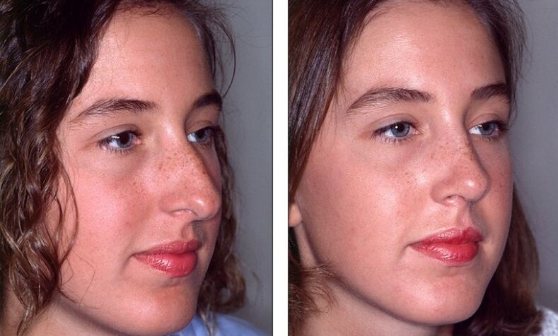 Nase vor und nach einer fehlgeschlagenen Nasenkorrektur