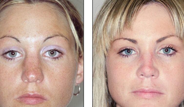 Vor und nach einer fehlgeschlagenen Nasenkorrektur