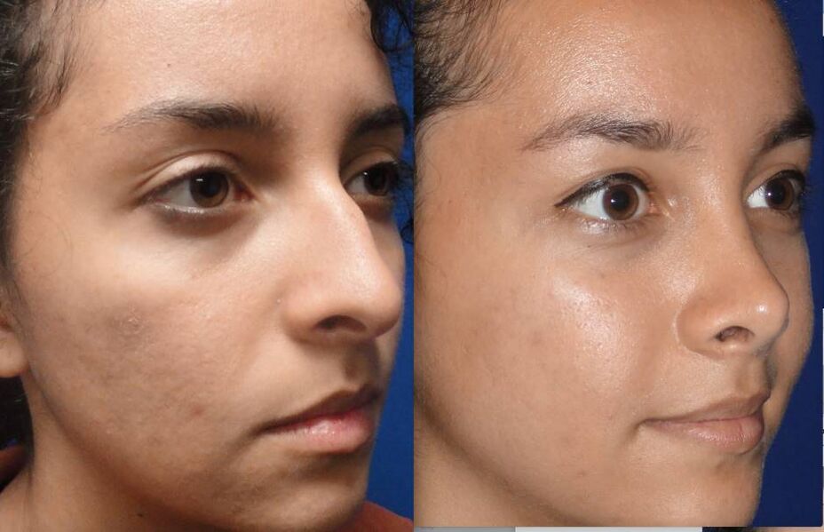 Fotos vor und nach einer geschlossenen Nasenkorrektur