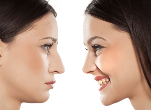 Nasenkorrektur Nase vor und nach