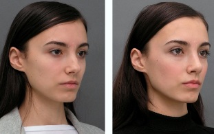 Mädchen vor und nach Rhinoplastik Nase