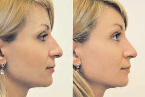 Nicht-chirurgische Nasenkorrektur vor und nach Fotos