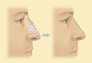 Wie ist sparsam Nasenkorrektur